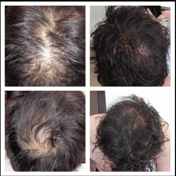 micropigmentación-capilar-clínicas-tricopigmentación-madrid-alopecia-precio