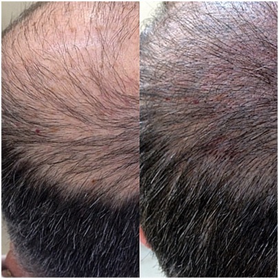 micropigmentación-capilar-madrid-aldemar-duración-resultados-tricopigmentación-pelo
