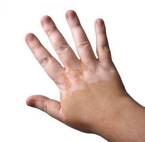 vitiligo micropigmentación madrid precios