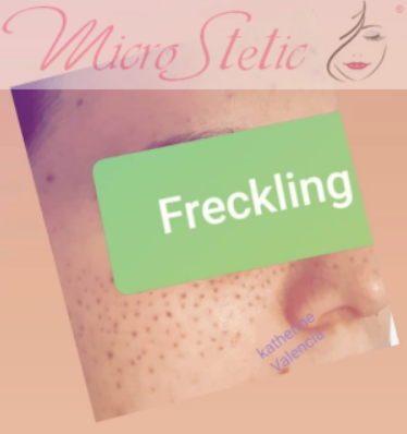 freckling-madrid-micropigmentacion-pecas-precio